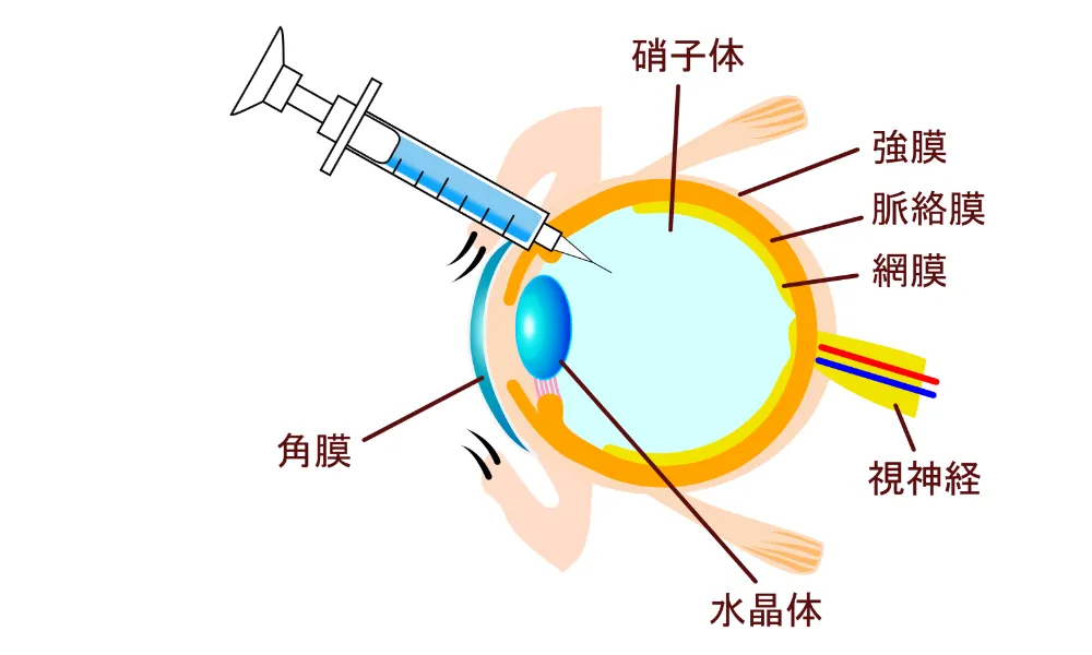 硝子体注射